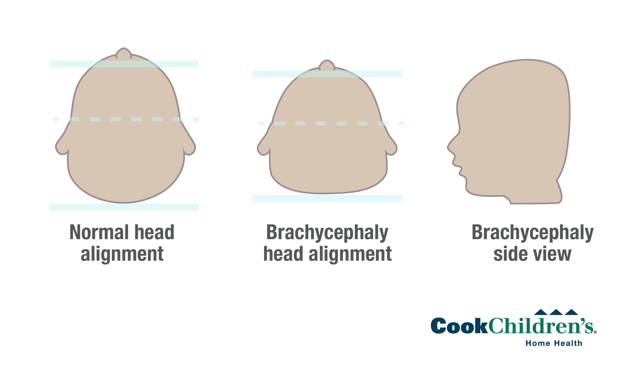 brachycephaly positional diagram