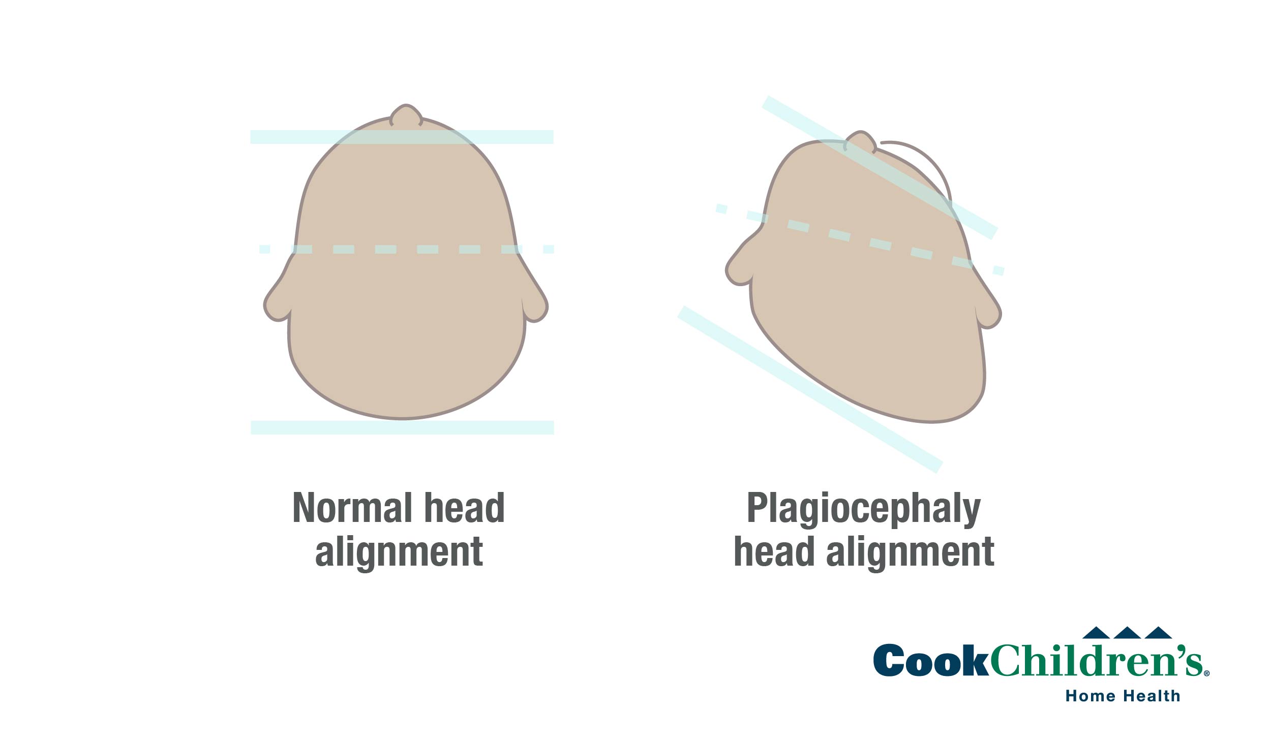 plagiocephaly positional diagram