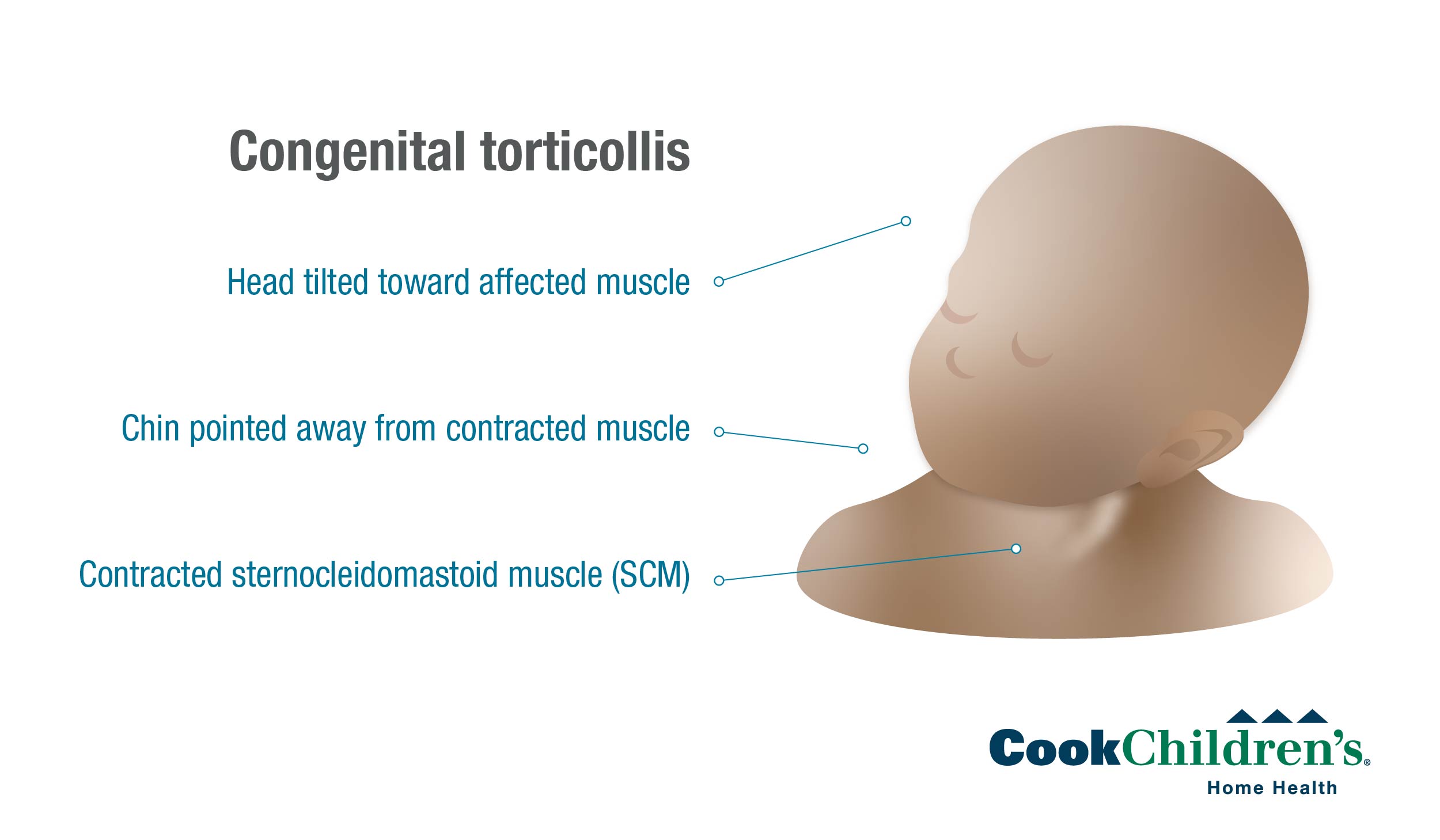 congenital torticollis diagram